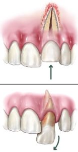 Dislodged teeth